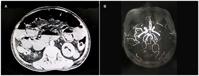 Ultrasound-guided transversus abdominis plane block as an effective anesthetic technique for transverse colostomy in a high-risk elderly patient: A case report